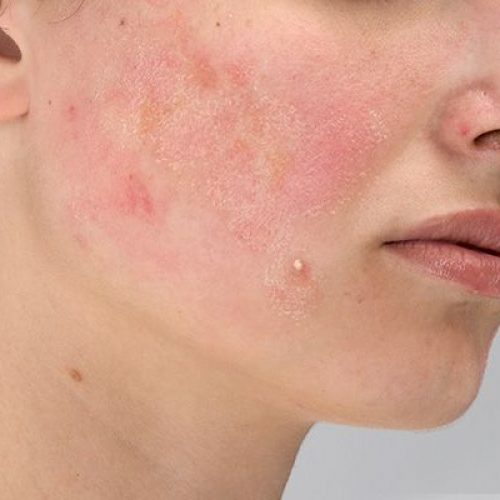 600x400_Acne_Article_6